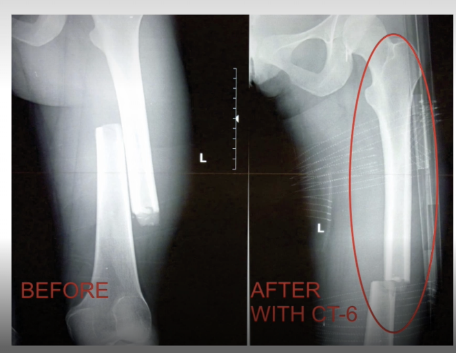<p>can be anywhere on shaft —> pain, deformity, angulation, muscle spasms and external rotation @ fracture site</p><p>up to 1 L of blood loss —> can present w <strong>shock</strong> symptoms (just from upper leg alone)</p><p>risk of vascular/nerve damage if bone fragments injure vessels/nerves</p>
