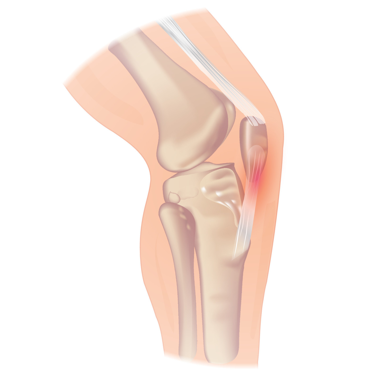 <p>patellar </p>
