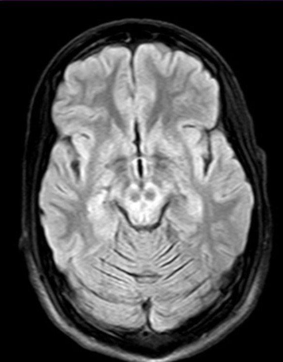 <p>20 year-old female presents with tremor and dystonia</p>