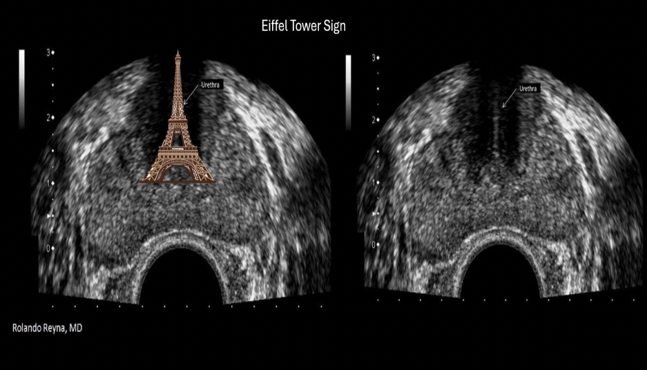 <p>C. normal prostate</p><p>Eiffel tower sign refers to shadowing created by dense tissues in the area of the urethra and verumontanum of the prostate.</p>