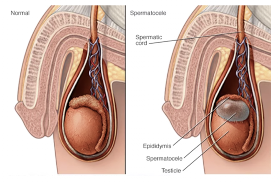 <p><strong>benign</strong> retention <strong>cyst</strong> containing <strong>milky fluid and sperm</strong> that develops between the <strong>head</strong> of the <strong>epididymis and the testicle</strong>.</p><ul><li><p>vary in size</p></li><li><p>little = incidental finding from ultrasound (does not cause problems)</p></li><li><p>can affect fertility since where sperm located </p></li></ul><p></p>