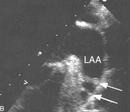 <ul><li><p>tissue separating <span style="color: rgb(0, 124, 255);">LAA</span> and <span style="color: rgb(0, 124, 255);">LUPV</span></p></li><li><p>may be confused w/ clot</p></li></ul><p></p>