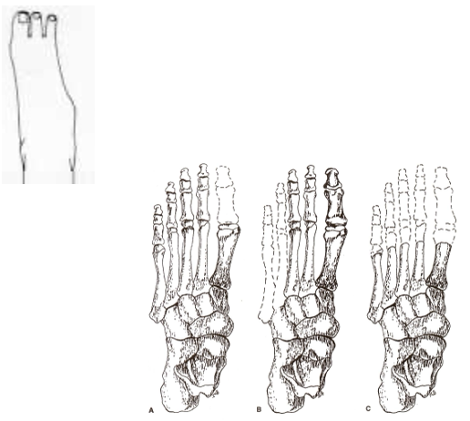 <p style="text-align: left;"><span>Dysvascularity or trauma (including frostbite, gangrene, infection)</span></p>