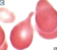 <p>"Teardrop cells"</p>