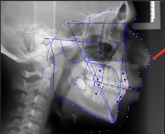 <p>which anatomical landmark:</p><p>- Most anterior point of the curve of the nose</p><p>- Pronasale</p>