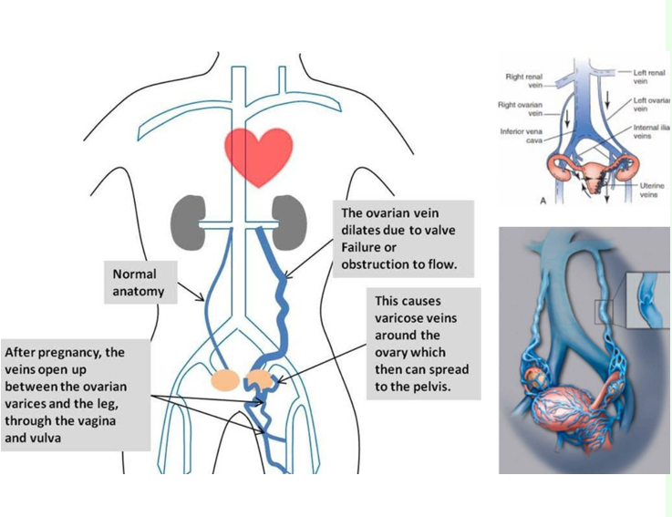 <p>occurs from varicose ovarian veins</p><ul><li><p>mostly from left ovary since left ovarian vein inserts into the left renal vein </p></li></ul><p>pelvic pain with not discernable cause </p><p>you can see dilated tortuous veins more than 10mm in size</p><p></p>