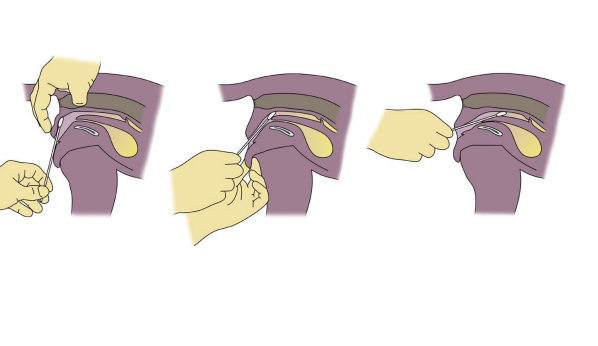 <ol><li><p>Clean the vulvar area </p></li><li><p>Vulvar labia are parted and everted if possible </p></li><li><p>Insert a premoistened cotton tipped applicator into the vagina (go dorsocranial until the advancement stops)- may use a speculum</p></li><li><p>Rotate the swab, remove and transfer to slide </p></li><li><p>Goal is to obtain sample of epithelial cells from the vagina, not the vulva </p></li></ol><p></p>