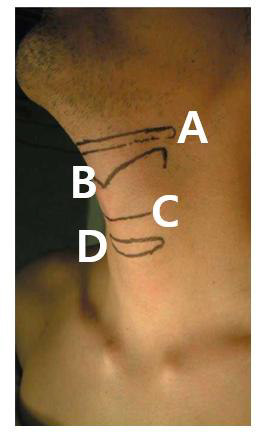 <p>Cricothyroidotomy 하는 동영상 나오고 incision 부위는?</p>