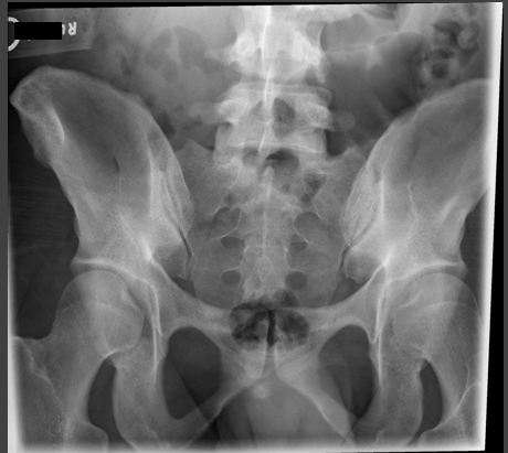 <p>critique sacrum AP axial </p>