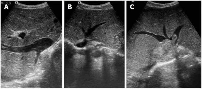 <p>thrombus within hepatic veins </p>