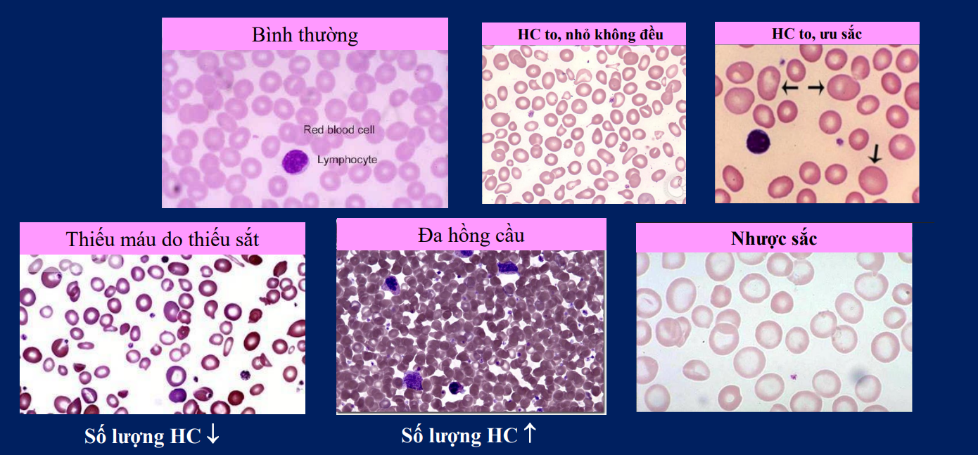 <p>Thiếu máu thiếu sắt:Thiếu Hb→nhược sắc, hồng cầu nhỏ, méo mó, vi trường thưa </p><p>Đa hồng cầu:Đa hồng cầu nguyên phát(tăng sinh tủy), thứ phát(thiếu máu oxy kéo dài→tăng ethyropoietin</p><p>Hồng cầu to nhỏ không đều:thiếu oxy hoặc các vấn đề di truyền, thiếu máu thiếu sắt→giải phóng cả hồng cầu lưới(hồng cầu non nên nhỏ), các hồng cầu méo mó các kiểu</p><p>Hồng cầu nhược sắc:thiếu máu thiếu sắc, bệnh tan máu…</p><p>Hồng cầu to, ưu sắc:hồng cầu khổng lồ(thiếu acid folic hoặc B12)</p>