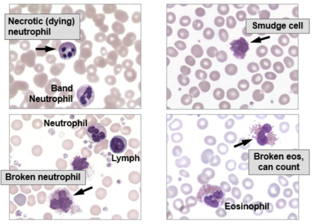 <ul><li><p><span style="background-color: transparent;">Deviations from normal reference ranges may indicate disease → provide clues to diagnosis</span></p></li><li><p><span style="background-color: transparent;">No immature cells should be present</span></p></li><li><p><span style="background-color: transparent;">May see occasional smudge, broke, or dying cells</span></p></li><li><p><span style="background-color: transparent;">Critical Value: Blast Cells</span></p></li></ul><p></p>