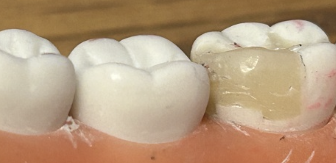 <p>How would you correct this restoration?</p>