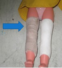 <p>fracture of the patellar with open wound,</p><p>swelling and infection</p>