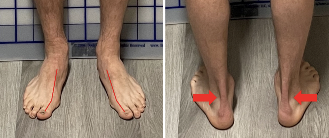 <p>Collapsed arches &amp; Big toe valgus: how to fix</p>