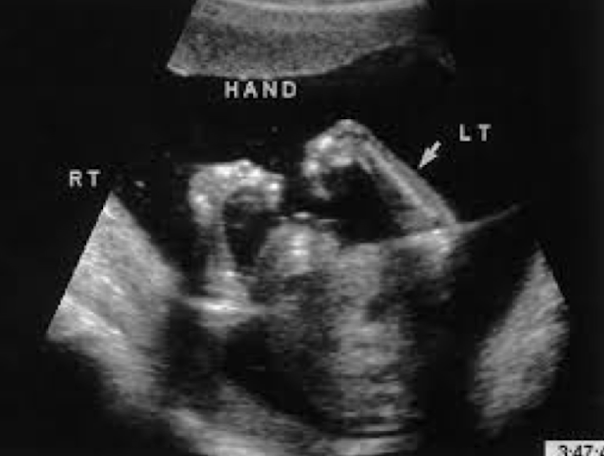<ul><li><p><span style="color: red;">hypoplasia or aplasia of the radius and ulna</span></p></li><li><p>extreme angulation of the hand to the forearm</p></li><li><p>associated with chromosomal anomalies</p><ul><li><p>T13, T18, VACTERL</p></li></ul></li></ul><p></p>