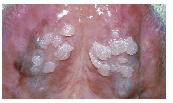 <p>1.what is this lesion?</p><p>2. how to treat/ manage it?</p><p>3. classification of oral lesion in HIV?</p>