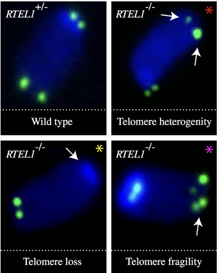 <p>RTEL1 mutations prevent TRF2 interaction, resulting in defective replication of telomeric DNA > telomere loss, gaps or fragility due to T loop excision  (Hoyeraal-Hreidarsson syndrome) </p><ul><li><p>this can be identified by double signals in telomere FISH of metaphase chromosomes</p></li></ul><p></p>