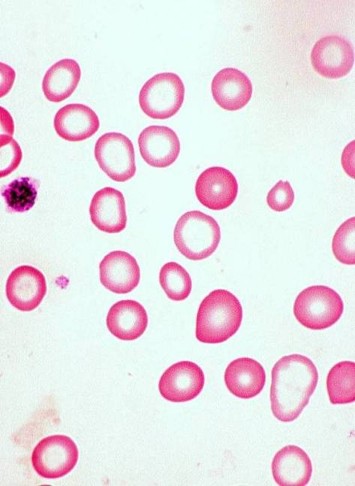 <p>less iron decreases RBC production, causes smaller RBC, causes pale RBC</p>