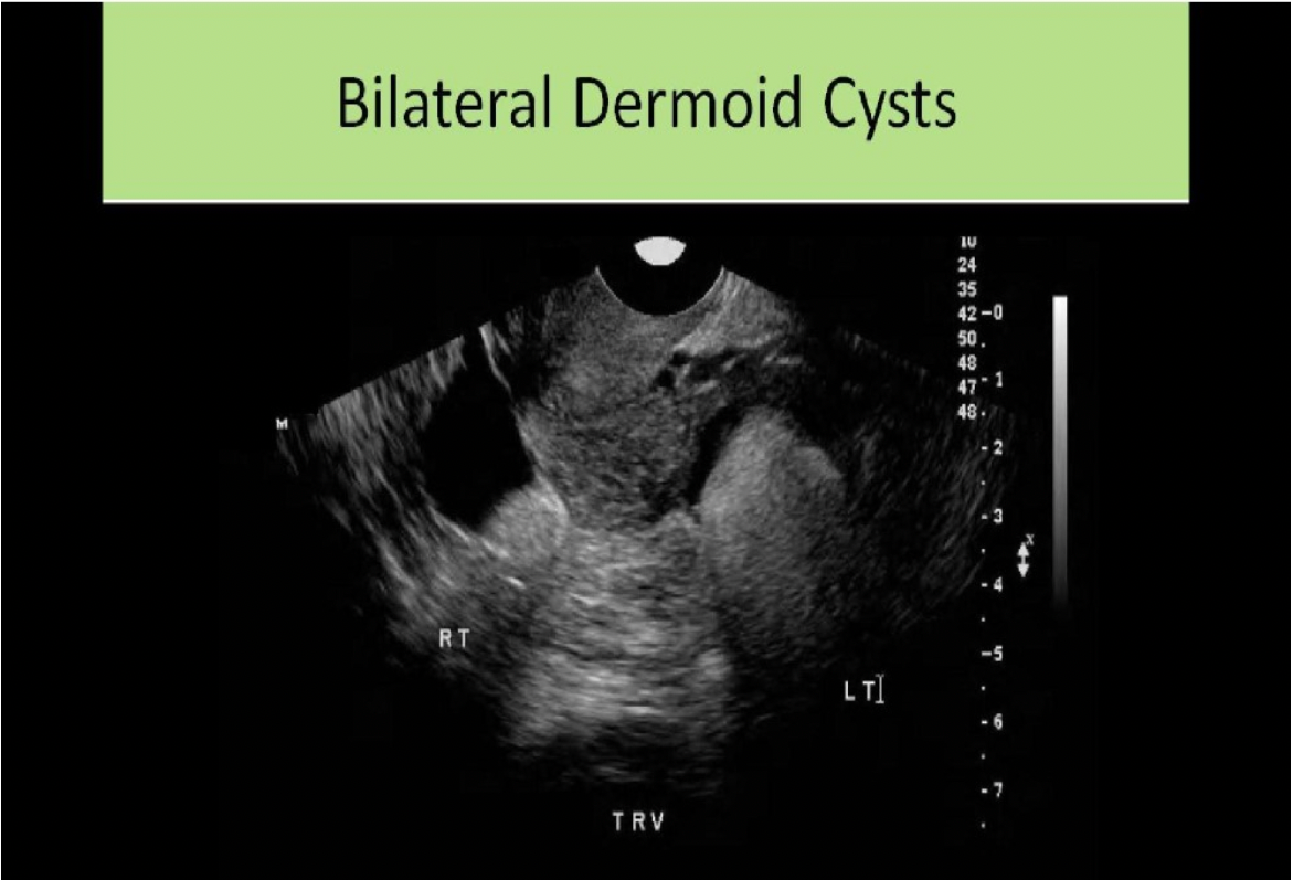 <p>C. Cystic teratoma</p><p>A dermoid cyst is usually composed of ectodermal tissues such as bone, hair and teeth causing a strong anterior reflection and posterior shadowing.</p>