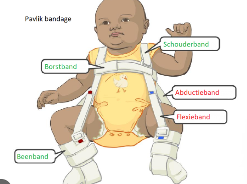 <p>Tijdens de eerst zes levensmaanden is repositie mogelijk met een Pavlikbandage. Hierdoor gaan de spieren geleidelijk aan ontspannen waarna spontane repositie optreedt.</p><p>Als de luxatie al langer aanwezig is wordt repositie moeilijker door de ontstane verkorting van de spieren. Als spreiden (abductie) in het heupgewricht moeilijk is en de femurkop te ver uit de kom staat kan tractie overwogen worden. De femurkop wordt hier eerst naar de kom getrokken waarna de benen langzaam worden gespreid, als de spieren zo voldoende ontspannen zal de femurkop in de kom schieten en is de heup gereponeerd. Vroeger werd dit gedaan met een katrol en gewichten, nu meestal met een spreidbroek of bandage.</p><p>Iedere repositie wordt gecontroleerd met een echo. Als repositie niet lukt of als de heup telkens weer luxeert kan artrografie gebeuren onder algehele anesthesie. Er wordt dan contrast ingespoten in het heupgewricht om de contouren van de kom en femurkop te kunnen bekijken, zo kan ook de stabiliteit van de heup na repositie worden getest. Als het niet lukt om door manipulatie de femurkop in de kop te krijgen kan het heupgewricht zo nodig geopend worden. Meestal wordt erna een gipsbroek aangelegd.</p>