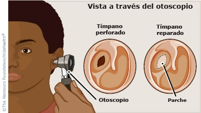 <p>Evitar canvis de pressió a l'oïda mitjana:</p><ul><li><p><strong>Mantenir la boca oberta en tossir o estornudar (EIR).</strong></p></li><li><p>Evitar mocar-se el nas amb força.</p></li><li><p>No viatjar en avió ni fer activitats aquàtiques.</p></li></ul><p></p>