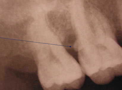 <p>-enamel pearl</p><p>-tends to involve furcation defects</p>