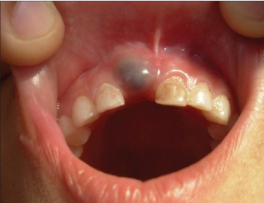 <p>12-year old male patient, which presented as a swelling involving the gingiva in the region of 11 of 5 year duration</p>