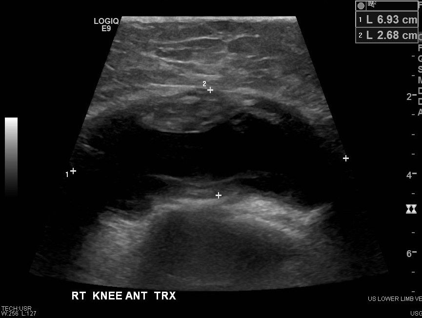 <p></p><p>joint effusion</p>