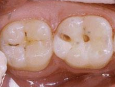<p>What surface are these carries located on? </p>