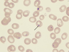<p>nuclear remnants (DNA), Usually pitted by spleen. seen in accelerated erythropoiesis. Postsplenectomy, thalassemia, hemolytic and megaloblastic anemias, sickle cell anemia</p>