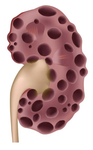 <ul><li><p>aka<span> </span><span style="color: yellow;">adult PKD</span></p></li><li><p>autosomal dominant congenital disorder that causes cystic dilation of nephrons and collecting tubules</p><ul><li><p>macrocysts in kidneys, liver, and pancreas</p></li></ul></li></ul><ul><li><p>may not be detected antenatally since it does not usually manifest until later in life</p></li><li><p>prognosis: variable when found in child</p></li></ul><p></p>