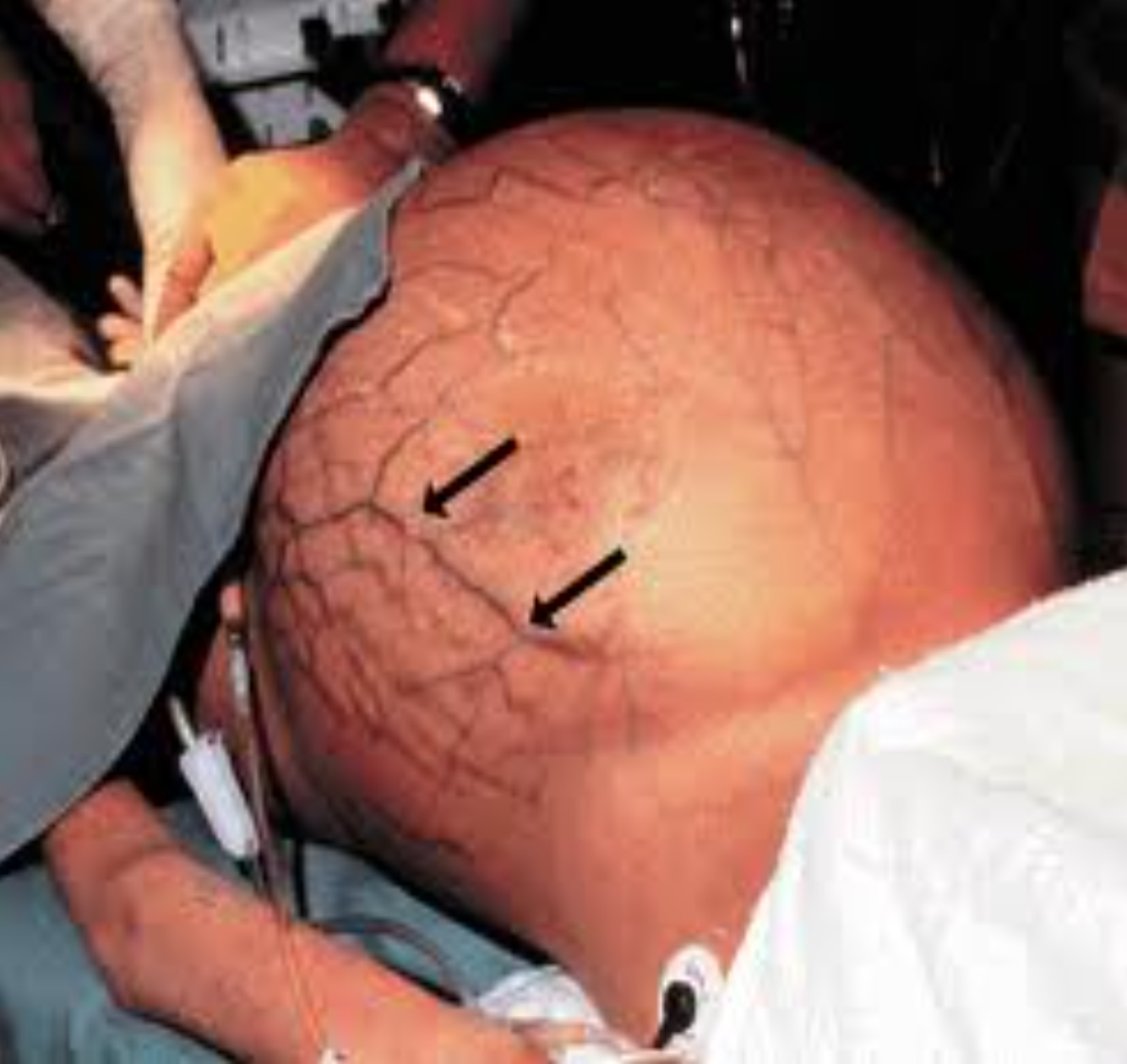 <p>Quan sát hình ảnh bụng bệnh nhân dưới đây. Dấu hiệu này gợi ý tình trạng nào sau đây?</p><p>A. Thoát vị rốn</p><p>B. Tuần hoàn bàng hệ</p><p>C. Phản ứng thành bụng</p><p>D. Phình động mạch chủ bụng</p>