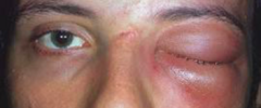 <p>Serious bacterial infection within the orbit</p><p>Fever, painful red eyelid, eye weakness, pain with eye movements, and proptosis</p>