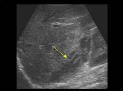 <p>is the blood in this hematoma fresh or older</p>