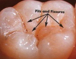 <p>Define the teeth landmark terminology: pit</p>