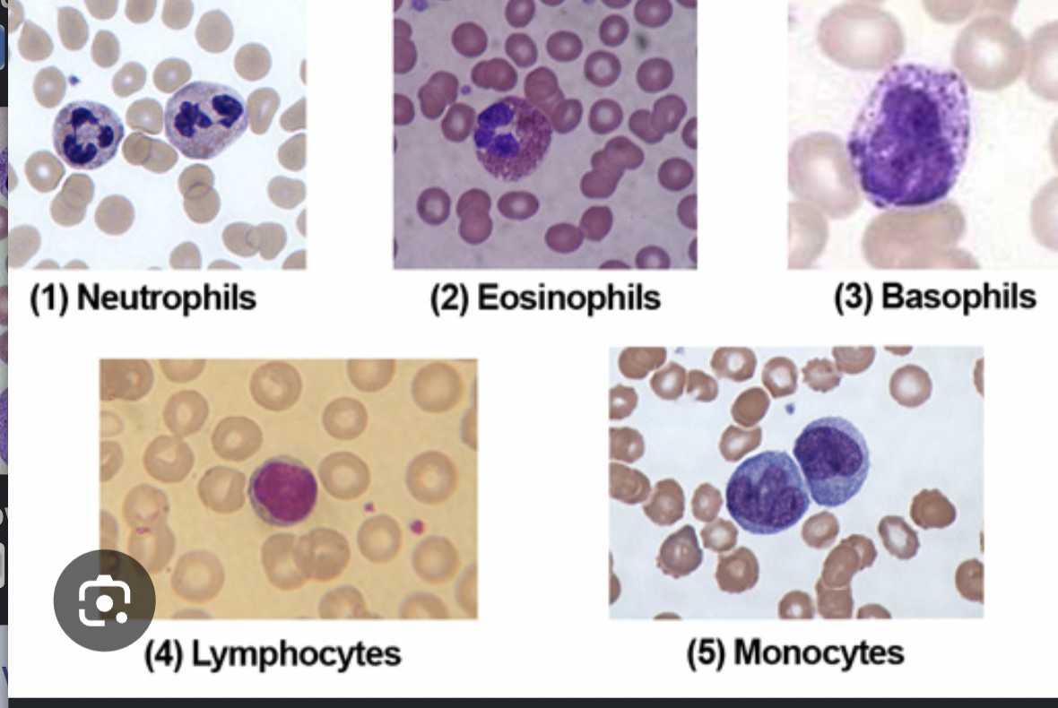 <p>Defensive blood cells: Leukocytes</p><p><span data-name="black_small_square" data-type="emoji">▪</span> Granulocytes</p><p>– Contain large granules that stain different colors</p><p>– Three types</p><p>• Basophils—stain blue with basic dye methylene blue, release inflammatory chemicals, do not phagocytize</p><p>• Eosinophils—stain red/orange with acidic dye</p><p>eosin, phagocytize pathogens, capable of diapedesis, allergies or parasites</p><p>• Neutrophils—stain lilac with mix of acidic and</p><p>basic dyes,  phagocytize pathogens, capable of diapedesis</p><p></p><p><span data-name="black_small_square" data-type="emoji">▪</span> Agranulocytes</p><p>– Cytoplasm appears uniform under a light microscope</p><p>– Two types</p><p>• Lymphocytes</p><p>• Most involved in adaptive immunity</p><p>• Natural killer lymphocytes</p><p>• Monocytes</p><p>• Leave the blood and mature into macrophages</p><p>• Phagocytic cells that devour foreign objects</p><p></p><p>Differential white blood cell count can signal</p><p>disease</p><p>• Increased eosinophils indicate allergies or</p><p>parasitic worm infection</p><p>• Bacterial diseases often show increase in</p><p>leukocytes and neutrophils</p><p>• Viral infections show increase in</p><p>lymphocytes</p>