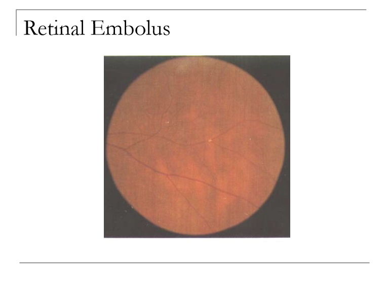 <p>Cardiovascular disease </p>