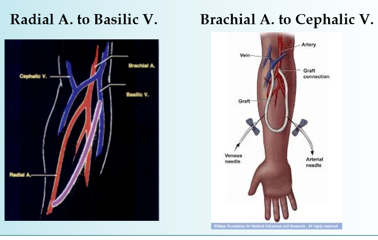 <p><strong>synthetic connection between artery and vein </strong></p><ul><li><p>looped plastic tube that essentially becomes an artificial vein </p></li><li><p>no need to develop (can be used 2 weeks after placement) </p></li><li><p><strong>used when small veins do not mature into fistula</strong></p></li></ul><p></p>