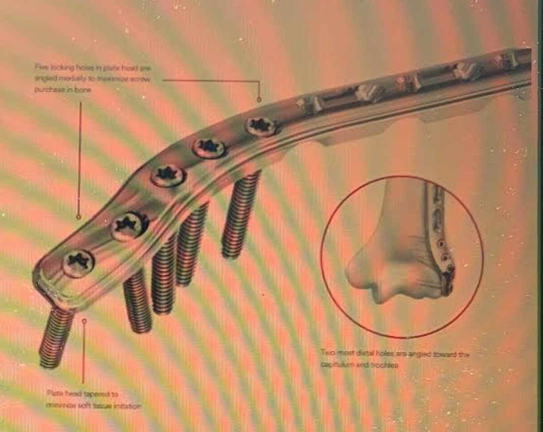<p>3.5mm LCP Extra-Articular Distal Humerus plate</p>