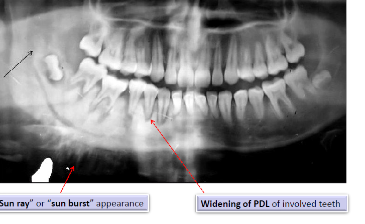 <ul><li><p>“sun ray” or “sun burst” appearance</p></li><li><p>widening of the PDL of involved teeth</p></li></ul><p></p>
