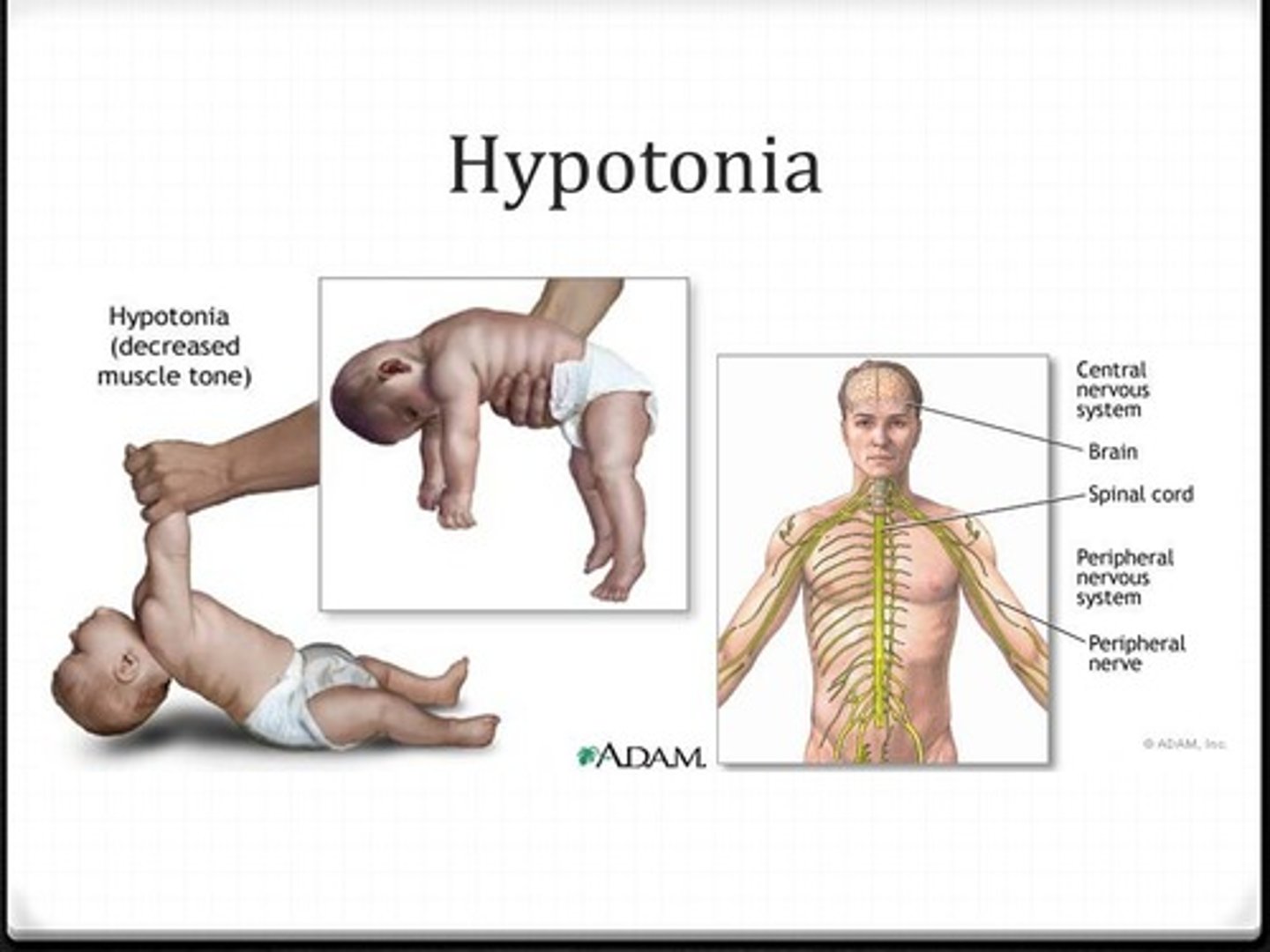 <p>Atrophy is when skeletal muscles actually decrease in size. Hypotonia is when skeletal muscles have less tone, meaning that the muscles are not as contracted when they are trying to relax their leg.</p>
