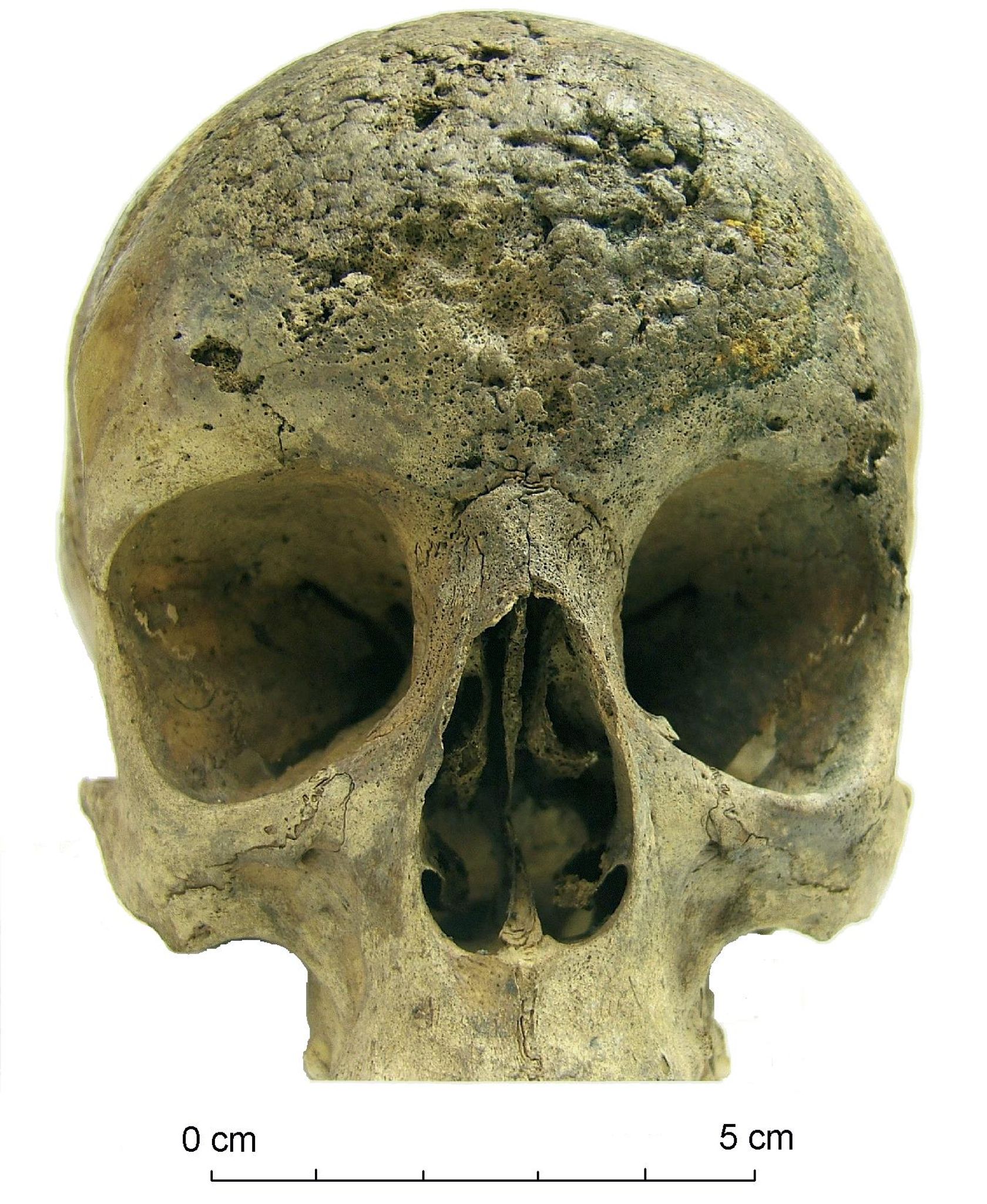 <p>Creates crater-like lesions with radiating lines; Skeletal involvement targets areas with minimal overlying soft tissue</p>