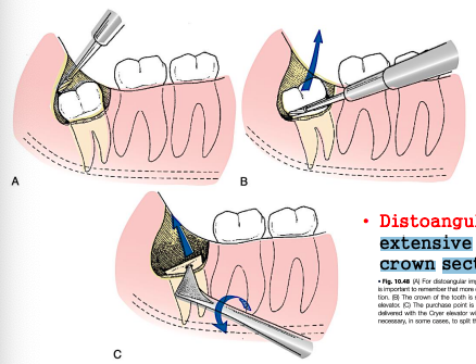 <p>most difficult</p><p>remove <span style="color: red;">buccal, occlusal, distal </span>bone</p><p>section crown from roots; remove<span style="color: red;"> crown first</span></p><p>tooth tends to <span style="color: red;">rotate distally</span>; careful elevation needed</p><p>roots delivered individually or together depending on fusion/divergence</p>