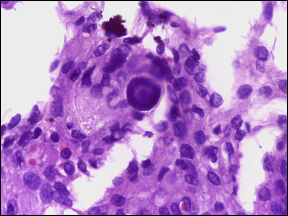 <p>papillary thyroid carcinoma dx</p>