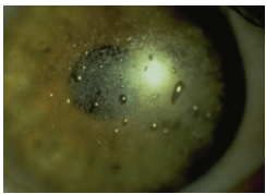 <ul><li><p>Own class (not GP or standard soft lens)</p></li><li><p>High MW cross-linked silicone polymer</p></li><li><p>Very high Dk (~340)</p></li><li><p>Used in pediatric aphakia (e.g., Silsoft)</p></li></ul><p></p>