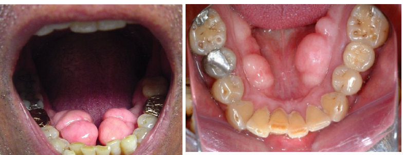 <p>torus mandibularis</p>