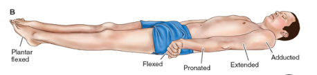 <p><strong>Decerebrate posture: </strong>Extension and external rotation of upper extremities with plantar flexion of the feet; an abnormal body posture associated with severe brain injury, characterized by extreme extension of the upper and lower extremities</p><ul><li><p>Decerebrate posturing indicates deeper and more severe dysfunction than does decorticate posturing; implies brain pathology; poor prognostic sign</p></li></ul><p></p>