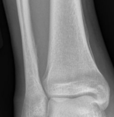 <p>What is this?</p><p>Triad:</p><p>- Digital clubbing</p><p> - 2 fingers together = Scamroth</p><p>- Symmetrical arthritis</p><p>- Metahyseal/ Diaphyseal periostitis</p>