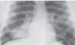 <p>This x-ray image indicates what pathology?</p>